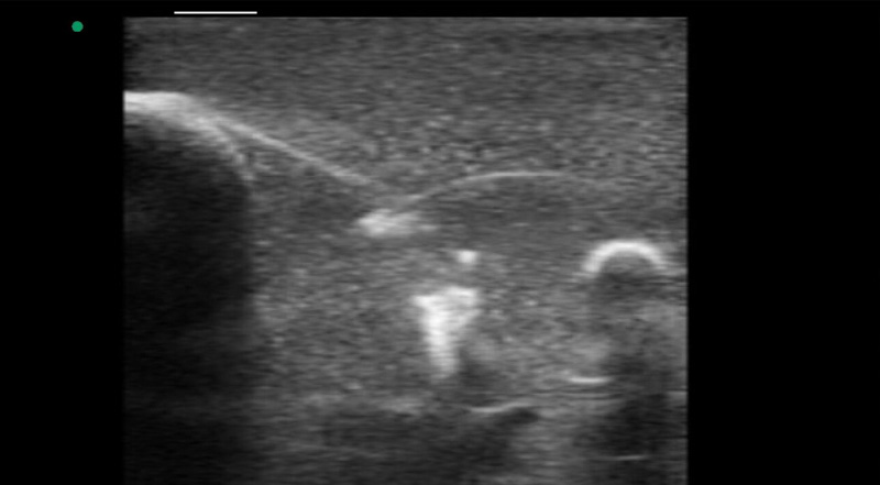 Wireless Ultrasound for Обучение биопсии груди