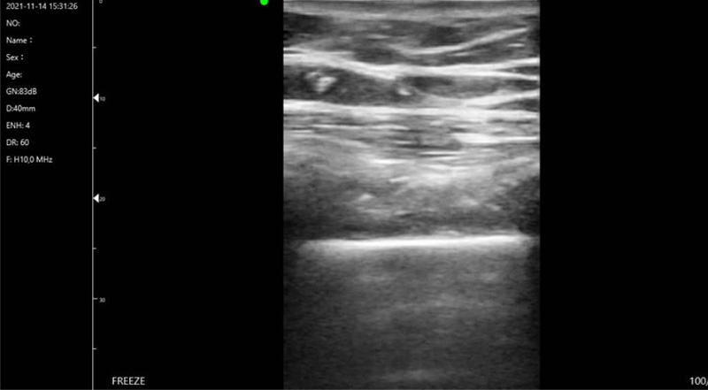 Wireless Ultrasound for C10T Легкое