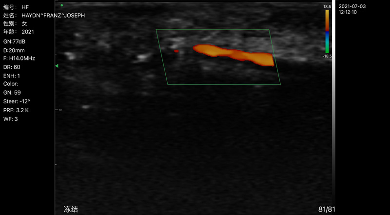 Wireless Ultrasound for Артерия пальцев