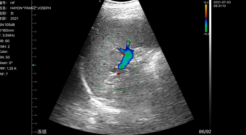 Wireless Ultrasound for Селезенка